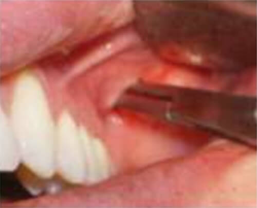 Fig 3. Kriller recto insertado a través de la incisión. De Lima Stevao, El Bychectomy or Bychatectomy: A Small and Simple Intraoral Surgical Procedure with Great Facial Results.