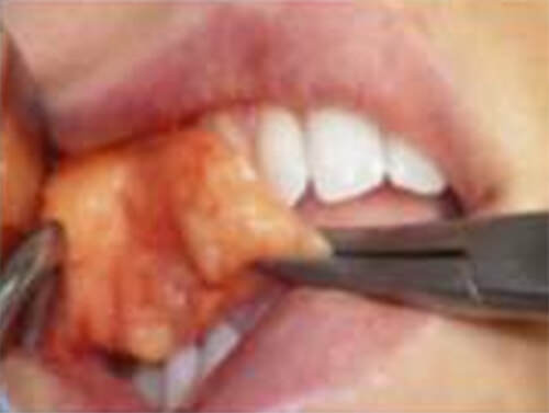 Fig 4. Extirpación de la bolsa adiposa de Bichat entera. De Lima Stevao, El Bychectomy or Bychatectomy: A Small and Simple Intraoral Surgical Procedure with Great Facial Results.