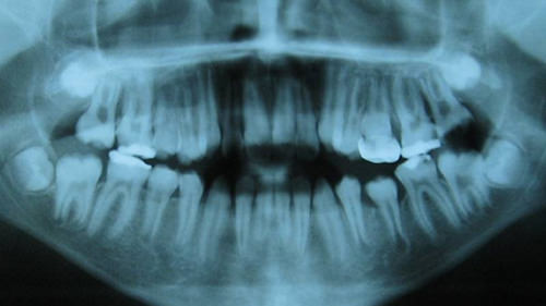 Figura 1 Radiografía panorámica inicial, se aprecia la falta de contraste entre esmalte y dentina y la destrucción de los primeros molares por fracturas post-eruptivas, cubiertos con un material radioopaco, segundos molares en erupción.