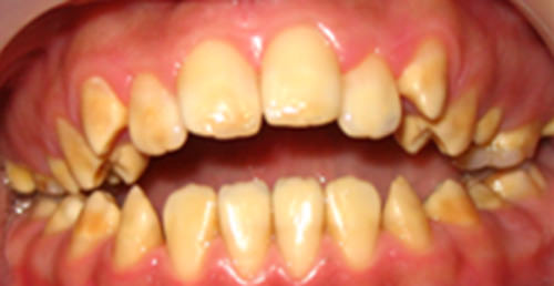 Figura 2 Fotografía inicial, todos los dientes afectados de diversa magnitud, la mordida abierta, gingivitis.