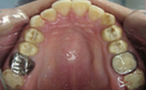 Figura 4 Vista oclusal. Tratamiento de transición. Corona diente 1.6 y banda metálica en diente 2.6. Los 2os molares protegidos con CVI.