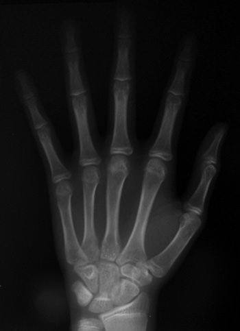 Foto 3 Radiografía de la mano y muñeca