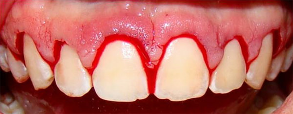 Foto 5 Retiro de collarín gingival