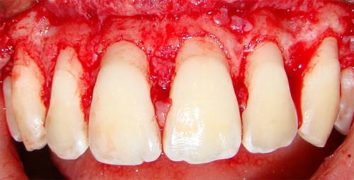 Foto 7 Luego de osteotomía y osteoplastia