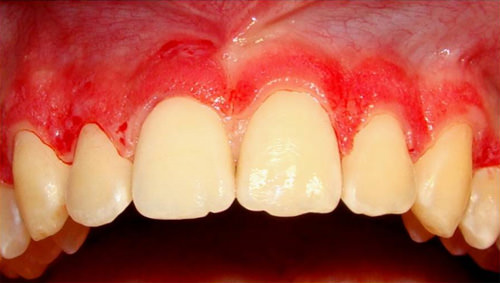 Foto 8 Plastia gingival