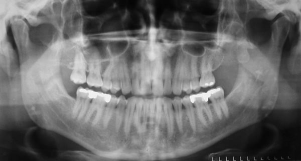 Figura 2 Radiografía panorámica sin aspectos radiográficos de lesión.