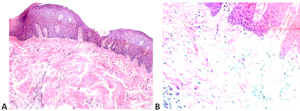 Figura 3A e 3B Epitelio escamoso con proliferación difusa de células pequeñas, exhibiendo atipia nuclear leve, invadiendo el colágeno del estroma circundante. Presencia de especies raras mitosis atípicas y evidenciadas (Fig. 3A-40X e Fig. 3B-100X).