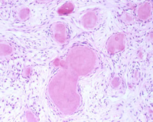 Fig.6 Histopatología