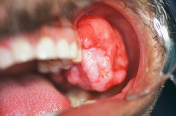 Figura 2 Aspecto intrabucal