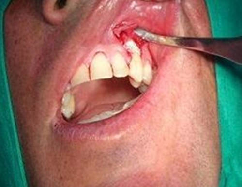 Fig. 2 Colocación de hidroxiapatita en 23.