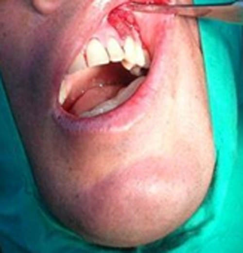 Fig.4 Colocación de Membracel en 23