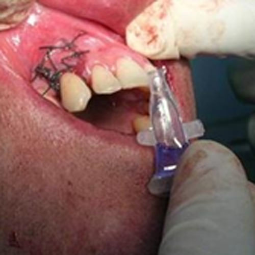 Fig. 5 Colocación de Tisuacryl ® como cemento periodontal