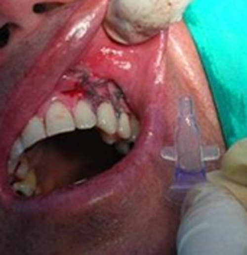 Fig. 6 Colocación de Tisuacryl ® como cemento periodontal