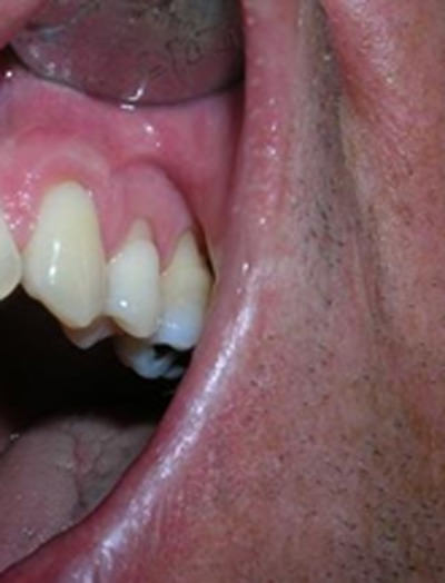 Fig. 7 Seis meses post-operatório en 13, la cantidad y calidad de encía lograda se mantiene estable en el tiempo.