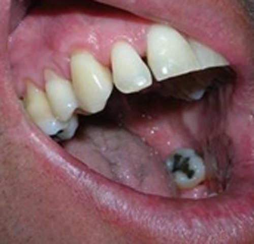 Fig. 8 Seis meses post-operatório en 23, la cantidad y calidad de encía lograda se mantiene estable en el tiempo.