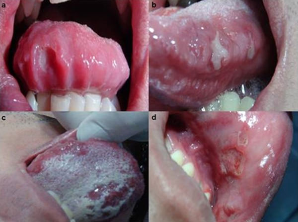 Figura 1 Aftas mayores a. borde anterior b. Bordes laterales c. Superficie dorsal de lengua d. Mucosa labial.