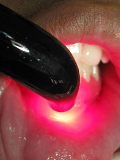 Figura 2 Aplicación de láser de baja intensidad en mucosa labial inferior.