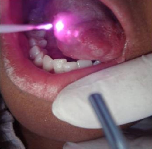 Figura 3 Aplicación de terapia láser en aftas mayores localizadas en lengua