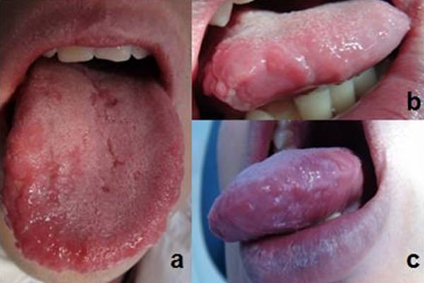 Figura 6 Cicatrización de las lesiones a. superficie dorsal de lengua b. borde lateral derecho c. Borde lateral izquierdo.