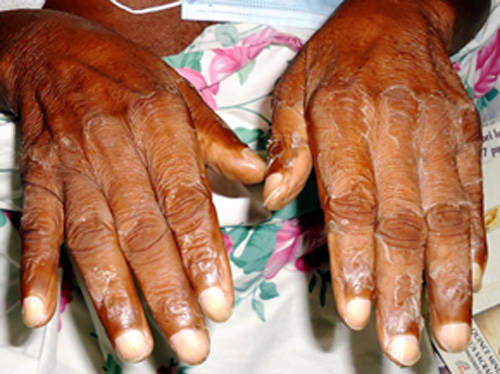 Figura 1 Fotografía del dorso de las manos de un paciente con dermatitis urémica, nótese la xerosis, ictiosis e hipohidrosis descamativa. 16.