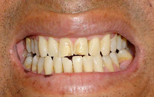 Figura 3 Fotografía donde se puede observar erosión del esmalte dental en los incisivos centrales superiores. 16