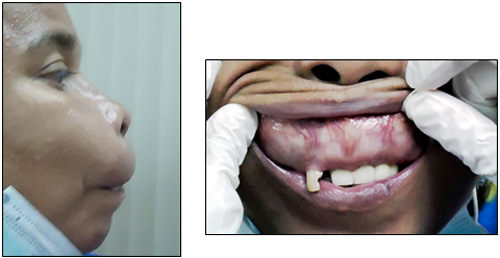 Figura 4 Fotografía extra e intraoral de una paciente con osteodistrofia renal. 16