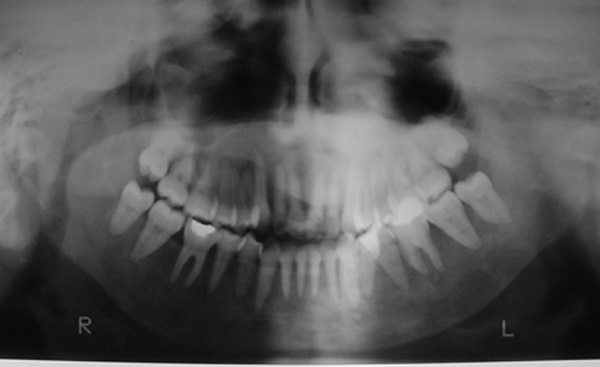 Figura 5 Radiografía panorámica de paciente con osteodistrofia renal destacándose la pérdida de la línea cortical, y el aspecto de vidrio esmerilado (cortesía de la Dra. María Herminia Bellorín)