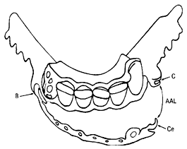 Fig. 2. Estructura Metálica de Swing - Lock. B, bisagra; C, cierre; Ce, cerrojo (en la barra vestibular); AAL, arco de apertura labial. Simmons, (1988)