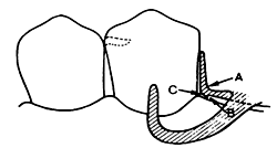 Fig. 3: En la base de la placa proximal una banda ligeramente aliviada de metal debe cubrir el margen gingival. A, es la linea de terminación Externa; B, es la linea de terminación interna; C, es la banda de metal. Jascobson, (1988)