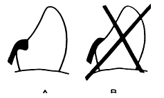 Fig. 4: A.- La preparación adecuada del descanso asegura la dirección axial de las tensiones; B.- efecto sobre plano inclinado por una preparación incorrecta. Jacobson, (1988)