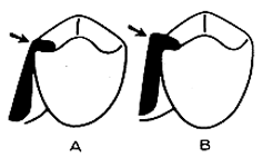 Fig. 5: A.-Sin la adecuada preparación del descanso (reducción del reborde marginal), puede resultar en áreas delgadas; B.- Un espesor mínimo de 1,5 mm es necesario para para prevenir la fractura. Jacobson, (1988)