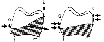 Fig. 6: El brazo reciprocador debe hacer contacto con el diente antes que el brazo retentivo pase por la altura de mayor contorno. Stewart y col, (1993)