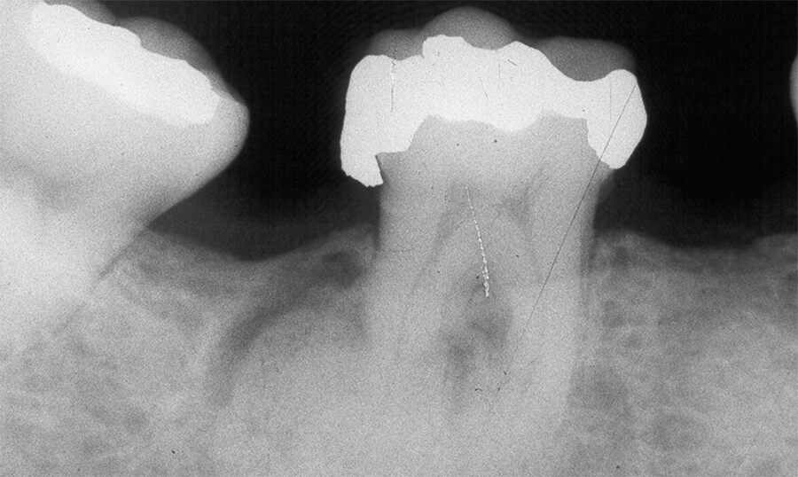 Fig. N°1: Radiografía Periapical que muestra imagen radiopaca en raíz distal del 46 con halo radiolúcido definido