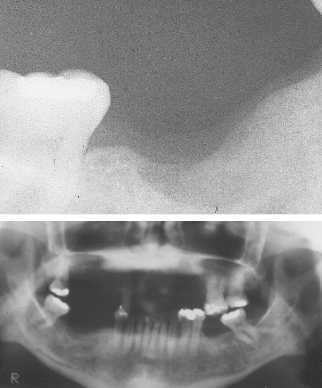 Fig. N° 4 y 5: Controles postoperatorio radiográficos de la lesión. A los 5 meses (Rx Periapical) y a los 18 meses (Rx Panorámica).