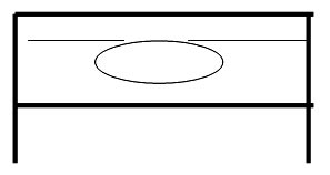 Figura 1. Diagrama de lesión en saca-bocado en el hueso alveolar. Tomado Dagenais y col. (1992). Oral Surg Oral Med Oral Path 74: 233