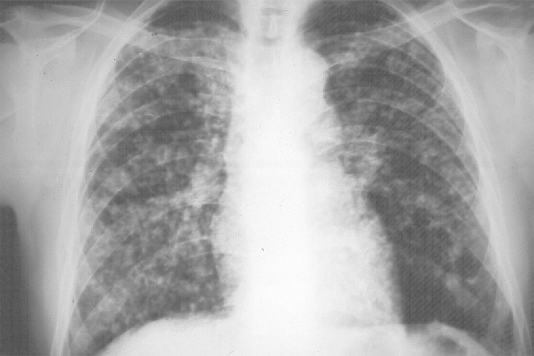 Fig. 2: Aspecto radiográfico (Rx. de torax) del paciente del caso # 1.
