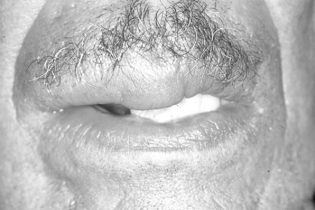 Fig. 4: Aspecto clínico extrabucal (macroquelia) del paciente.