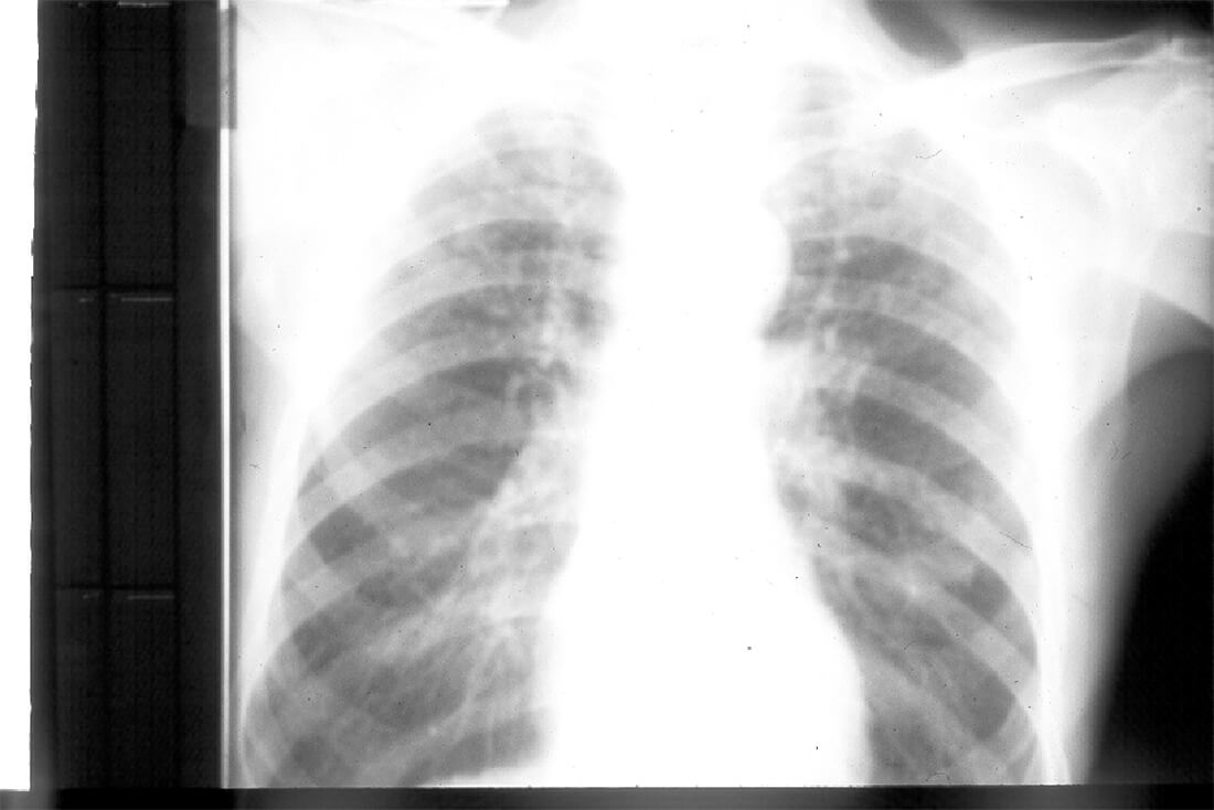 Fig. 5: Aspecto radiográfico (Rx. de torax) del paciente