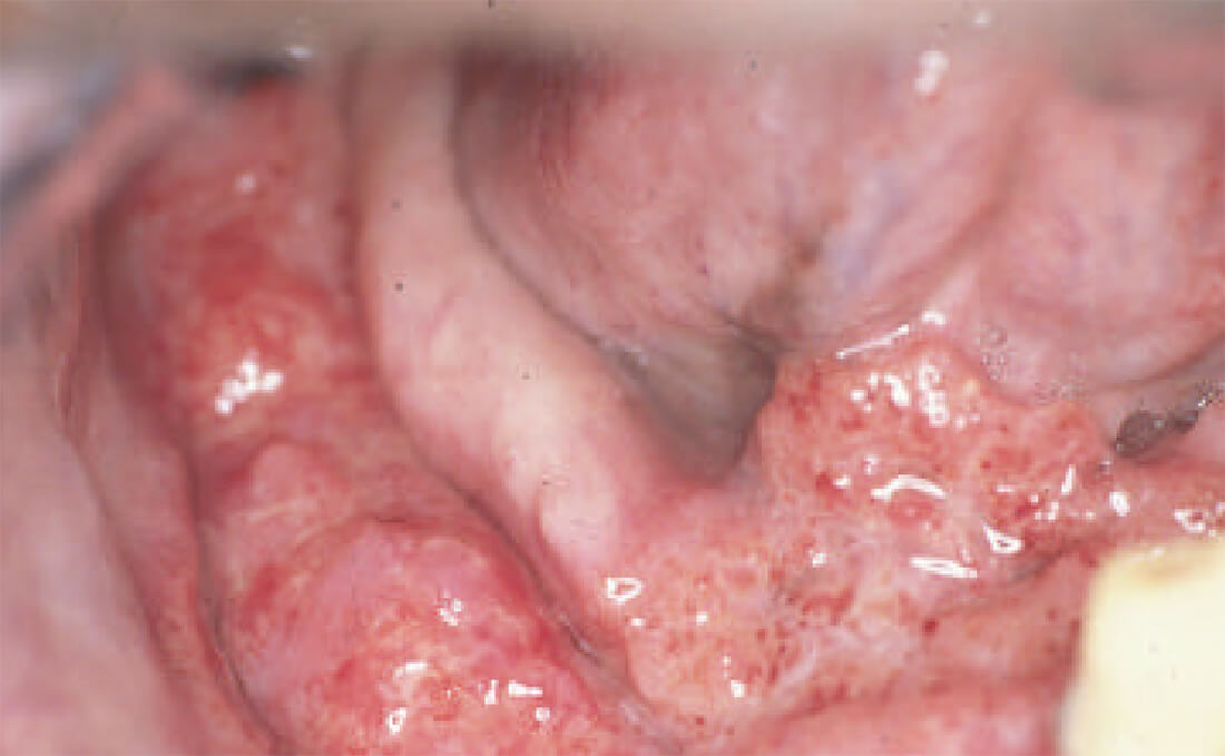 Fig. 1: Aspecto clínico intrabucal de lesión bucal del paciente del caso # 1.
