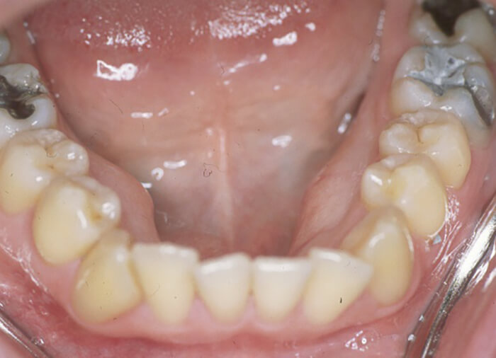 Fig. 2 Torus mandibular