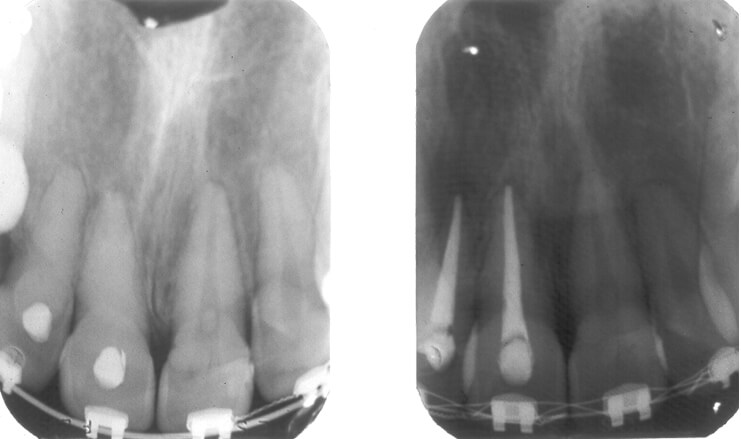 Figuras 29 a y 29 b