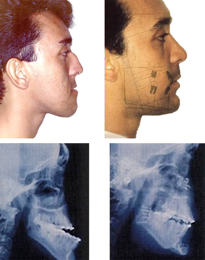 Figura 30. Foto de perfil inicial. Figura 31. Foto de perfil post quirúrgica. Figura 32. Radiografía cefálica lateral luego del tratamiento ortodóncico pre-quirúrgico. Figura 33. Radiografía cefálica lateral post Quirúrgica.