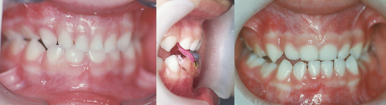 Figura 34. mordida cruzada anterior en dentición temporal. Figura 35. plano inclinado de mordida. Figura 36. mordida a tope luego de una semana de uso del plano inclinado.