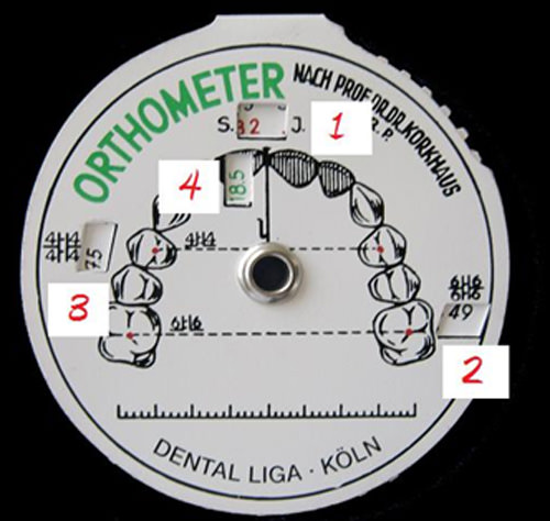 Fig.N°1 Ortómetro de Korkhaus:      Suma incisiva.     Dimensión transversal a nivel de la fosa mesial de los primeros molares     Dimensión transversal a nivel de la fosa central de primeros premolares     Longitud anterior, levantada desde de la dimensión transversal consignada en los premolares, perpendicular al centro de la papila de los incisivos centrales