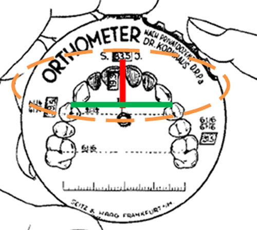 Fig.Nº 2 Mediciones de la dimensión transversal y de la longitud anterior, realizadas sobre el Ortómetro de Korkhaus.      En Verde: Medición que se realizó en sentido transversal de la fosa del 1° Premolar a 1° Premolar opuesto.     En Rojo: Medida Sagital del segmento anterior