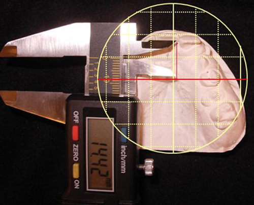 Fig. Nº 4 Medida anterior registrada con el calibrador digital sobre la platina de Korkhaus
