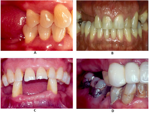 Figura 2 Grados de Complejidad. Grado I (A); Grado II (B); Grado III (C); Grado IV (D)