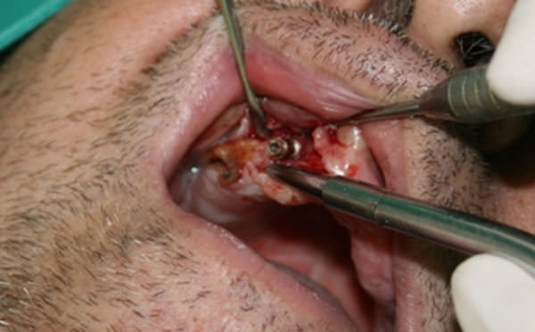 Fig. 1 Remoción del implante y del resto radicular.