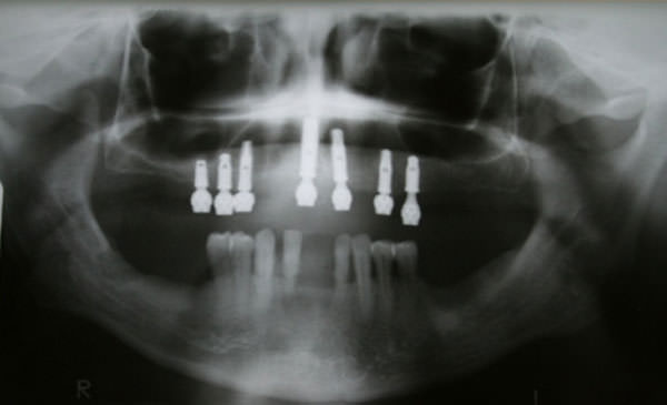 Fig.10 Radiografia panorámica con los mini pilares en posición.