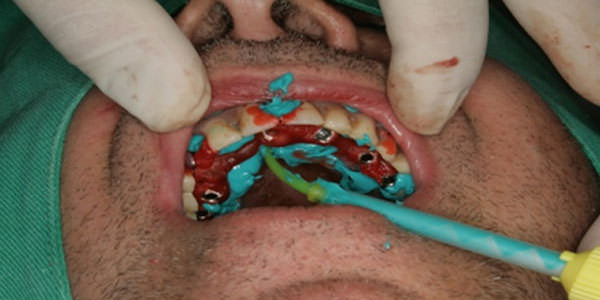 Fig.10 Vista oclusal del procedimento impresión de transferencia